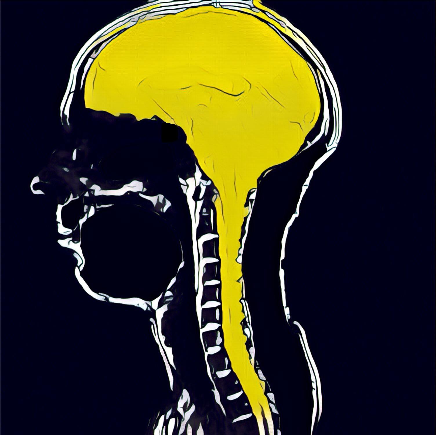 Image of brain scan. Brain and spinal cord is colored as bright yellow and the rest of the background is black.